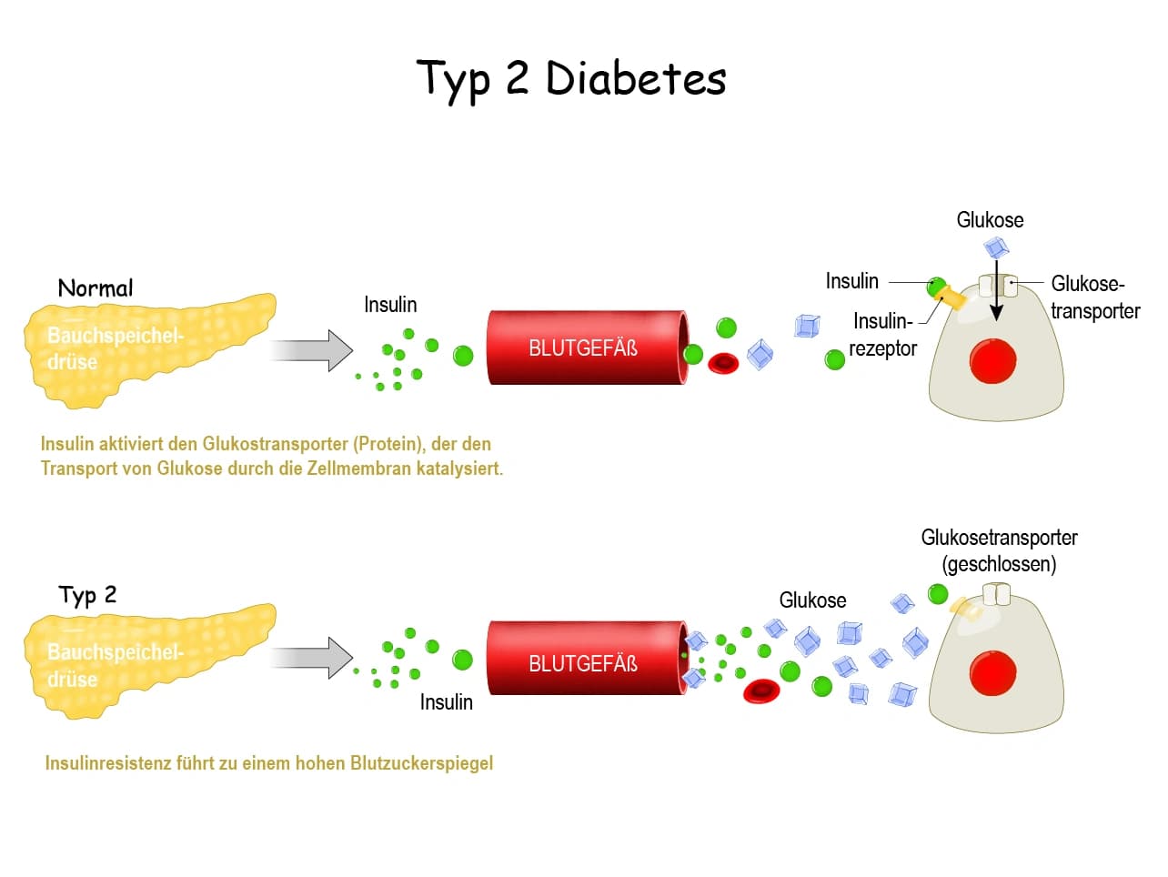 Grafik: Diabetes Typ 2