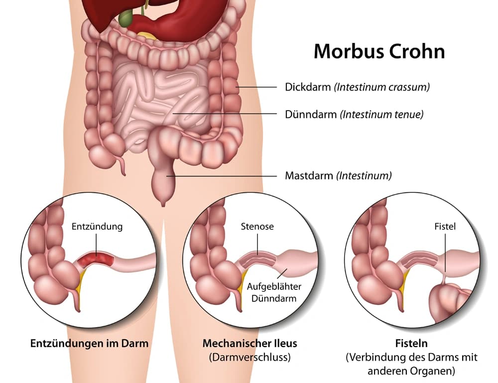 Morbus Crohn
