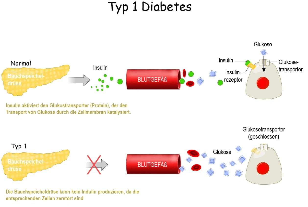 Grafik: Diabetes Typ 1