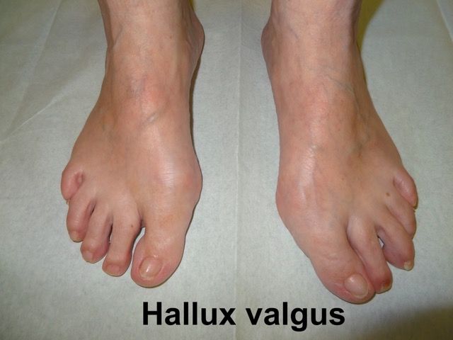 Hallux Valgus UCHHallux Valgus72