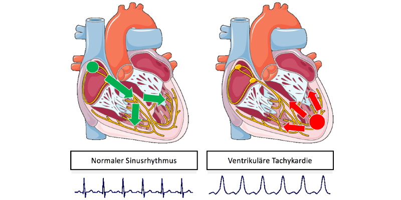 Vergleich Sinusrhythmus - Tachykardie Abbildung Vergleich Sinusrhythmus - Tachykardie