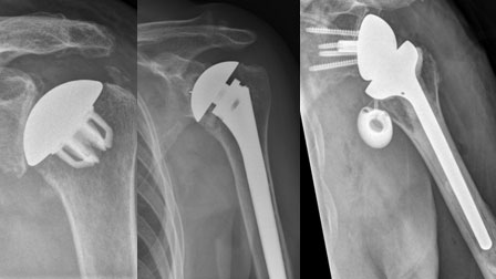Röntgenbild nach Implantation einer Kappenprothese, Schaftprothese und inversen Schultergelenkprothese Röntgenbild nach Implantation einer Kappenprothese, Schaftprothese und inversen Schultergelenkprothese
