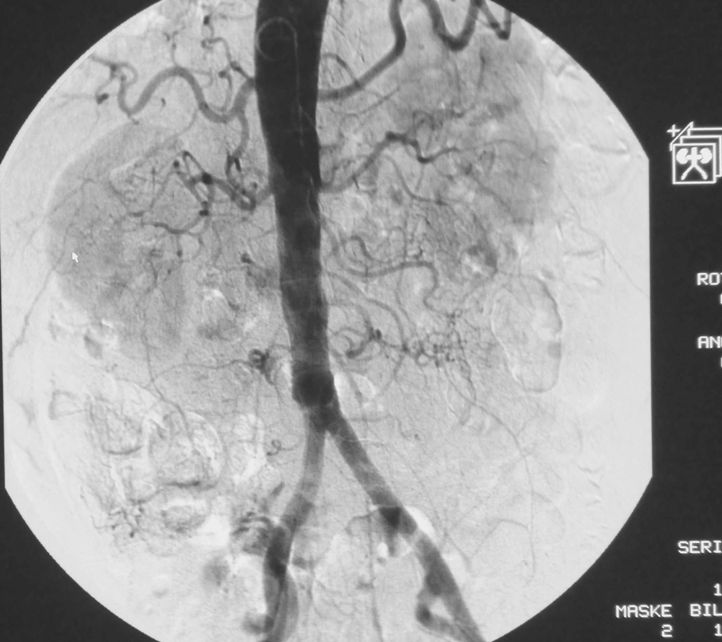Angiographie Angiographie