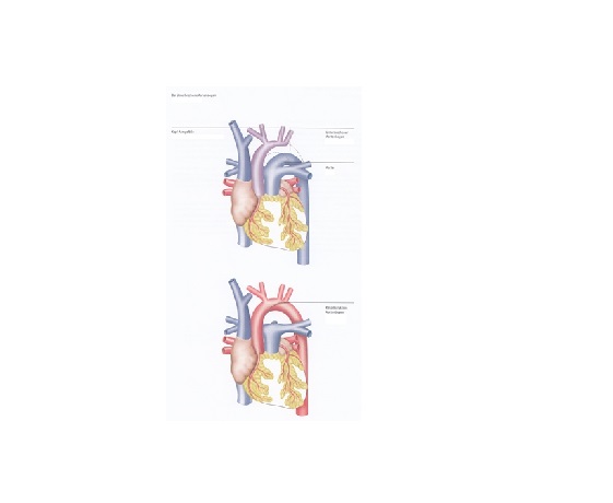 unterbrochener aortenbogen_dkhz_web unterbrochener aortenbogen_dkhz_web