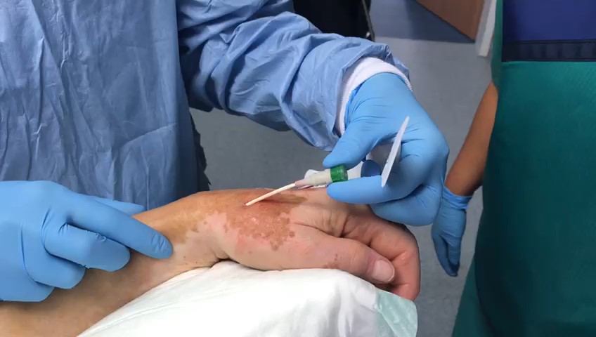 Zugang durch die Arteria tabatière Arteria tabatière