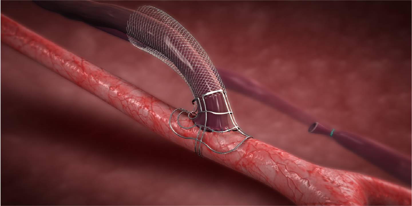 Shunt mit einem VasQ Device_Laminate Medical Technologies Ltd / Israel Shunt mit einem VasQ Device_Laminate Medical Technologies Ltd / Israel