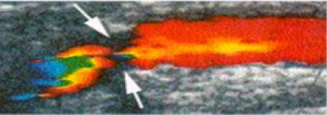 Duplexsonograhie Bild Ultraschalluntersuchung - Duplexsonographie