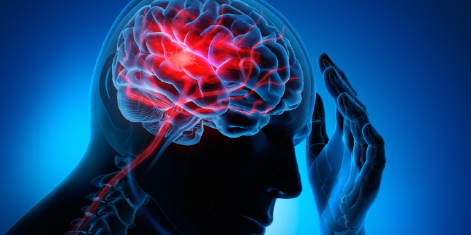 Schlaganfall Stroke Bild Schlaganfall Stroke