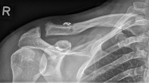 Röntgen postoperativ nach arthroskopischer Stabilisierung (Dog bone plate, Arthrex, Naples) Röntgen postoperativ nach arthroskopischer Stabilisierung (Dog bone plate, Arthrex, Naples)