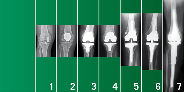 Auswahl an Knieendoprothesen Spektrum Gelenkersatz am Knie
