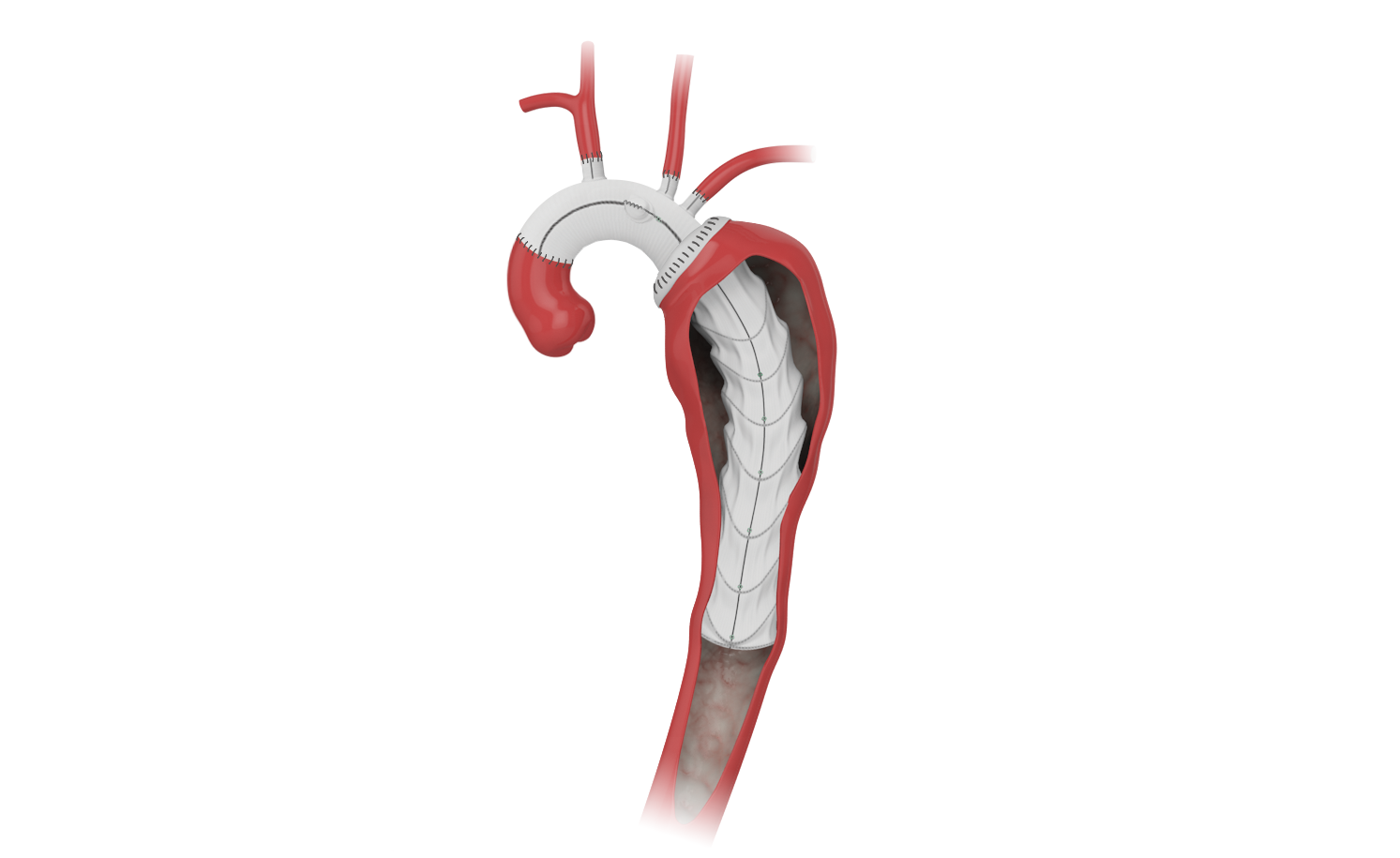 Aortenbogenersatz inkl. Prothesenversorgung Bild: Aortenbogenersatz inkl. Prothesenversorgung