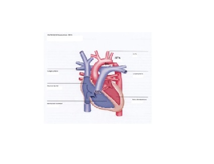 aortenisthmusstenose_1a_dkhz_web aortenisthmusstenose_1a_dkhz_web
