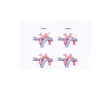 aortenisthmusstenose_2a_dkhz_web aortenisthmusstenose_2a_dkhz_web