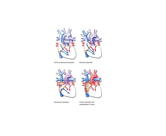 hypoplastisches linksherzsyndrom_dkhz_web hypoplastisches linksherzsyndrom_dkhz_web