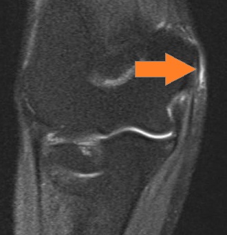 epicondylitis-pfeil02 epicondylitis-pfeil02