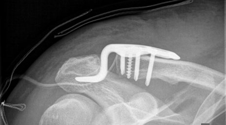 Hakenplatte (DepuySynthes) Hakenplatte (DepuySynthes)