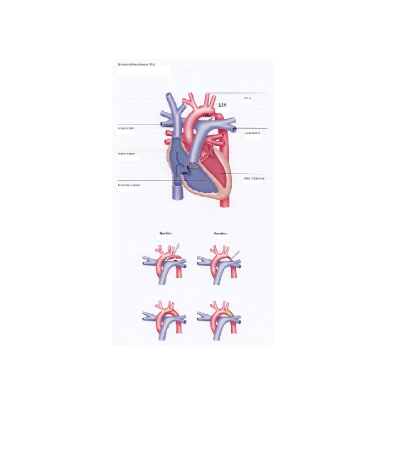 aortenisthmusstenose_dkhz_web aortenisthmusstenose_dkhz_web