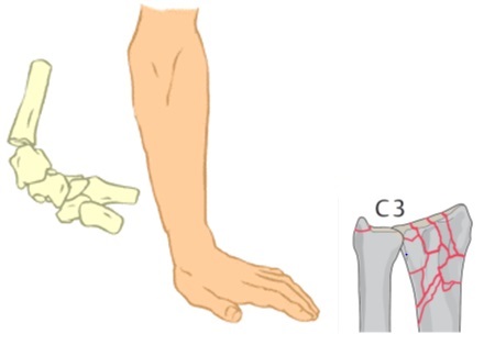Handgelenkverletzung Handgelenkverletzung