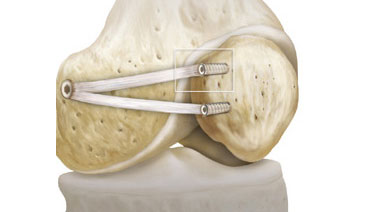 Fixierung der Gracilissehne an der Kniescheibe sowie am Oberschenkelknochen zur dynamischen Stabilisierung der Patella Fixierung der Gracilissehne an der Kniescheibe sowie am Oberschenkelknochen zur dynamischen Stabilisierung der Patella