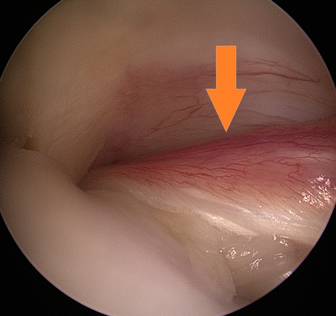lbs-tendinitis lbs-tendinitis
