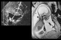 hydrozephalus_diagnostik hydrozephalus_diagnostik
