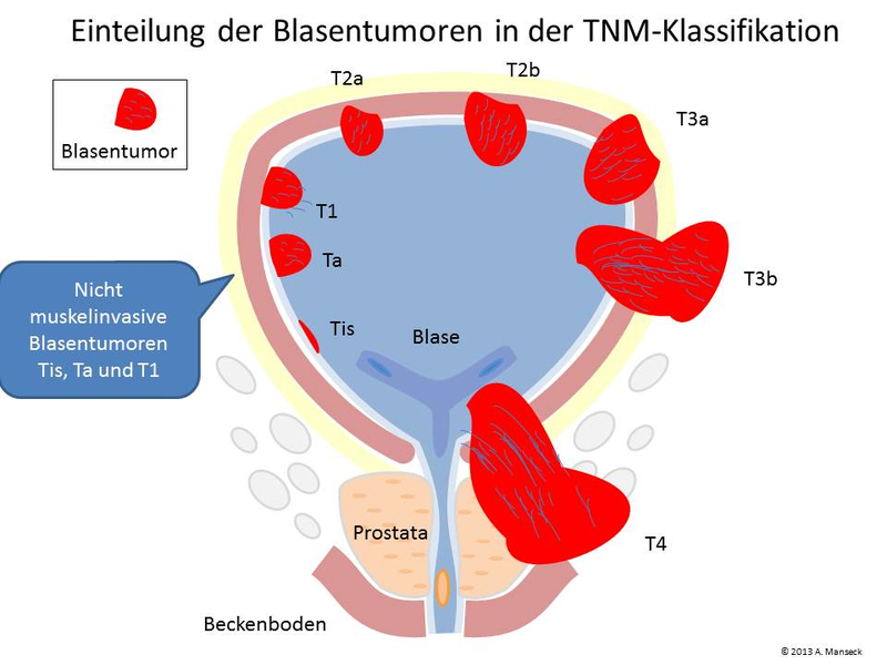 blasentumor tnk-klassifikation blasentumor tnk-klassifikation