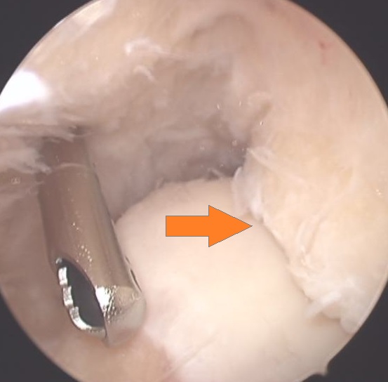 impingement-tibiaosteophyt impingement-tibiaosteophyt