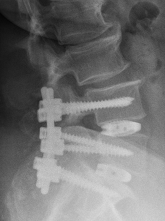 Instabilitäten an der Hals- und Lendenwirbelsäule - Asklepios Klinik