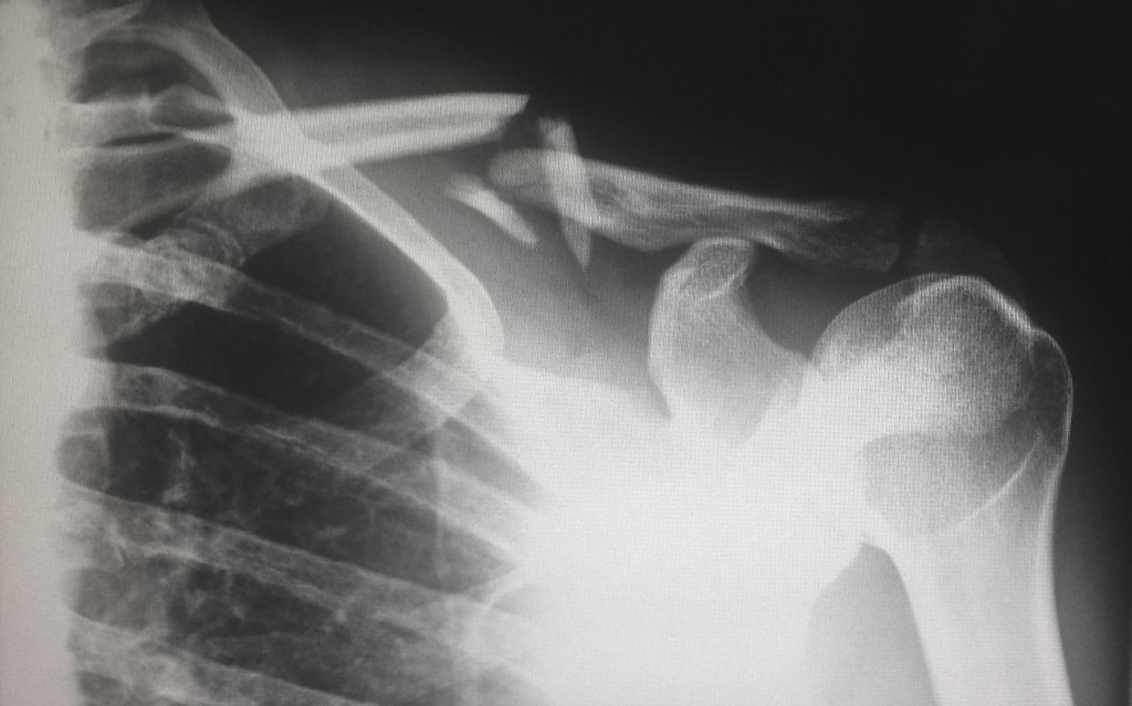 schluesselbein x-ray