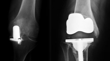 gelockerte Knie-Endoprothese gelockerte Knie-Endoprothese