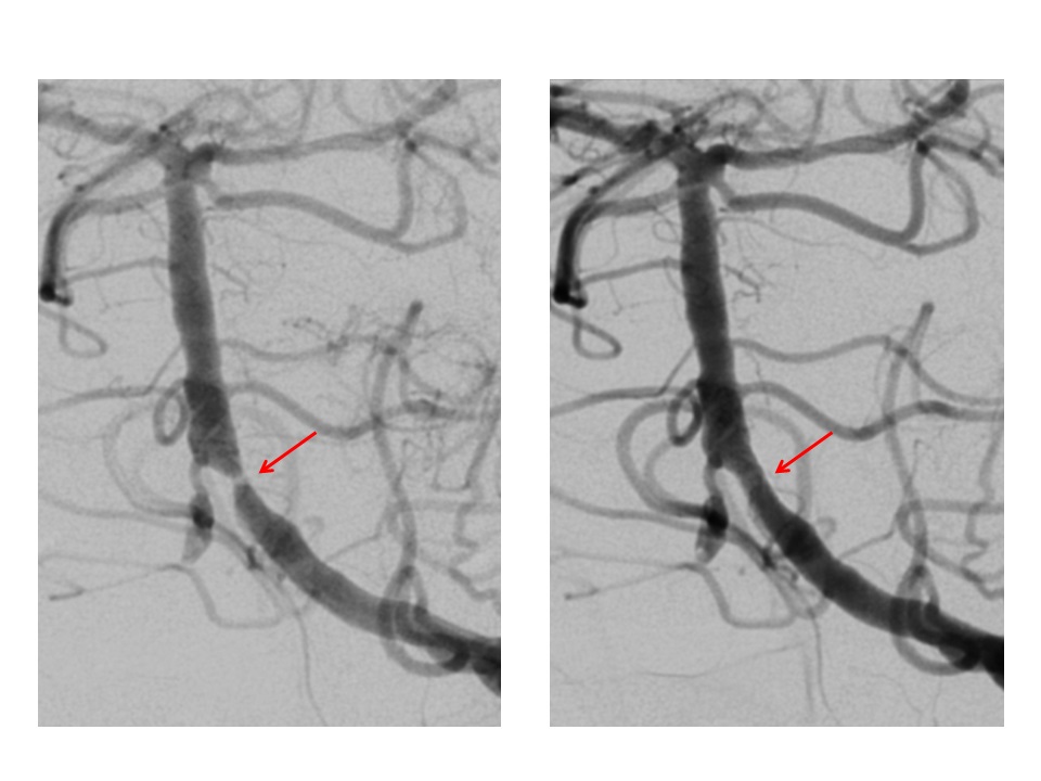 stent stent