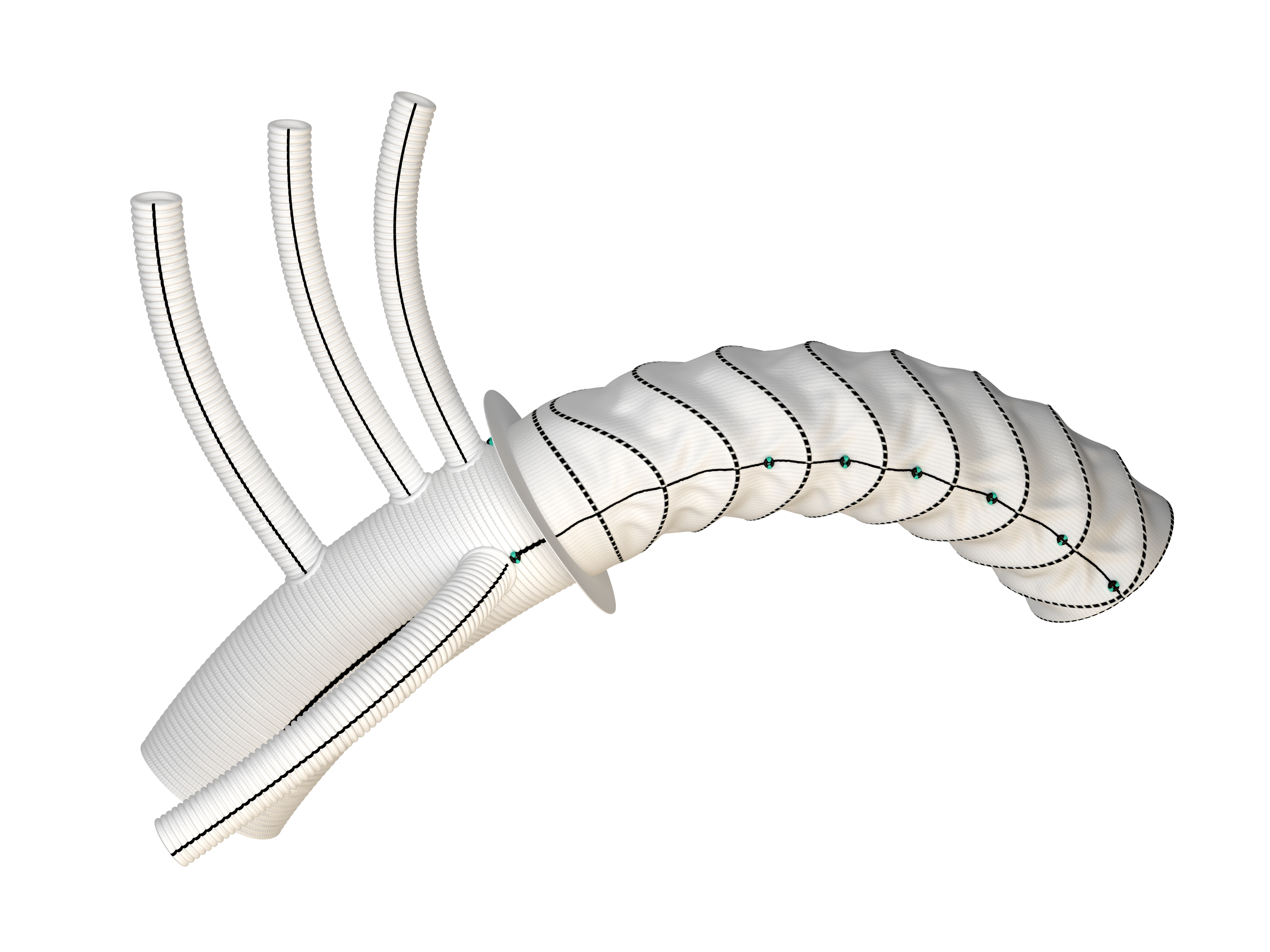 Hybridprothese mit Stentanteil Bild: Hybridprothese mit Stentanteil