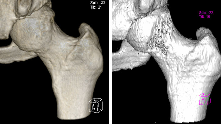 Femoroacetabuläres Impingement vor und nach knöcherner Korrektur im 3D-CT Femoroacetabuläres Impingement vor und nach knöcherner Korrektur im 3D-CT