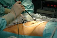 Minimalinvasive Chirurgie ACH_minimalinvasive Chir.2_72