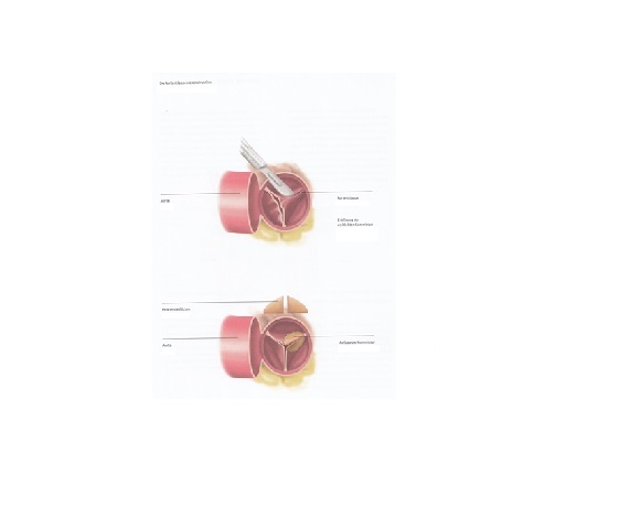 aortenklappenrekonstruktion_dkhz_web aortenklappenrekonstruktion_dkhz_web