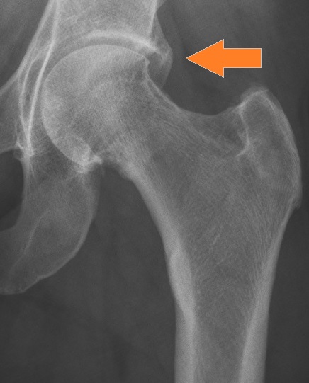 pinzer-impingement pinzer-impingement