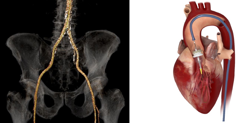 CT der Gefäße und Schemadarstellung einer Aortenklappenimplantation Abbildung CT der Gefäße und Schemadarstellung einer Aortenklappenimplantation