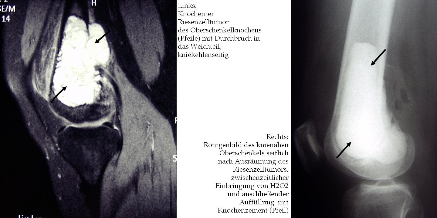 Collage Riesenzelltumor BILD: Collage von Röntgenbildern eines Riesenzelltumors