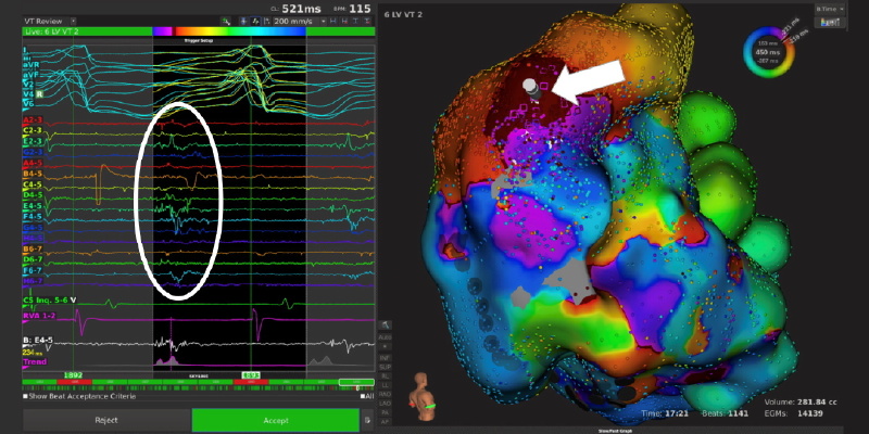 3D-Darstellung der Ausbreitung einer Ventrikülären Tachykardie Abblidung einer 3D-Darstellung der Ausbreitung einer Ventrikülären Tachykardie