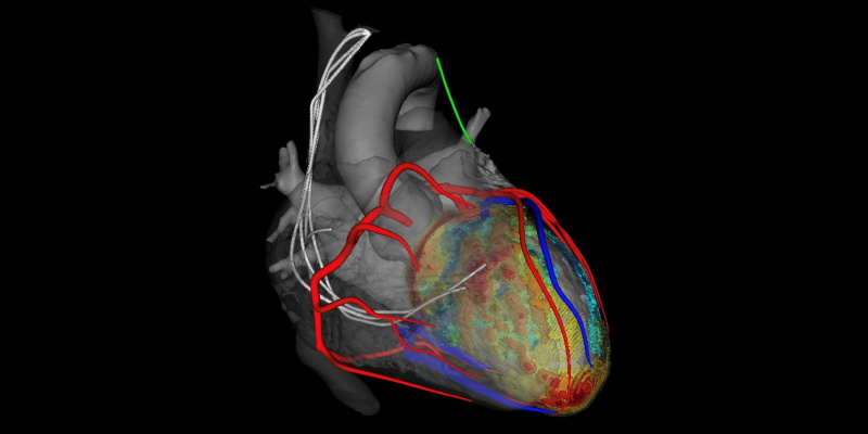 3D-CT-Aufnahme des Herzens 3D-CT-Aufnahme des Herzens