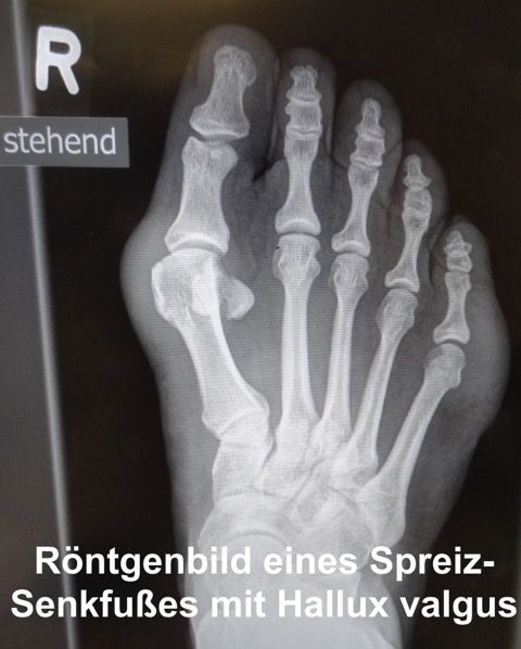 Röntgenbild Spreiz-Senkfuß mit Hallux Valgus UCHRöntgenbild Spreiz-Senkfuß mit Hallux Valgus72