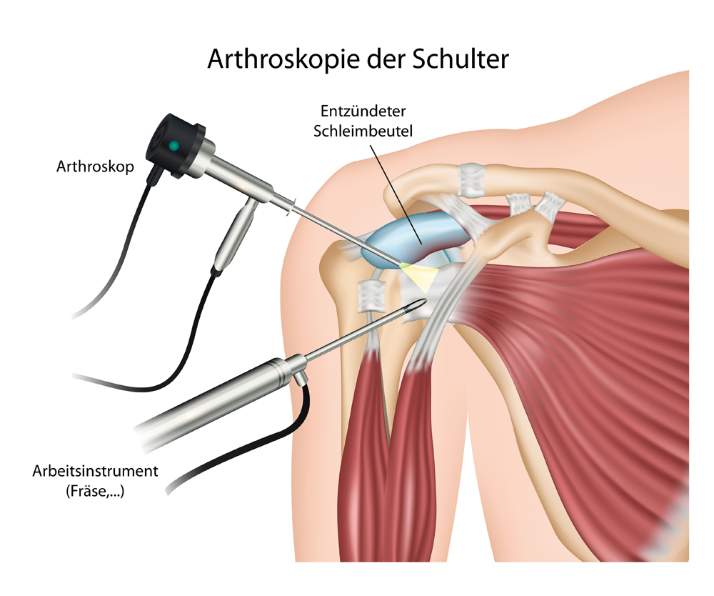 Arthroskopie Schulter Arthroskopie Schulter