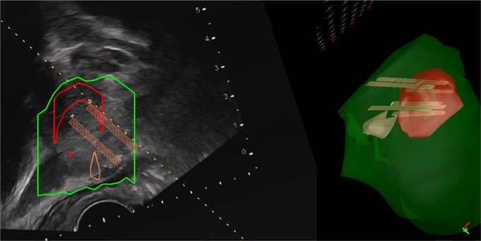 Screenshot Fusionsbiopsie BILD: Bildschirmfotografie einer Fusionsbiopsie