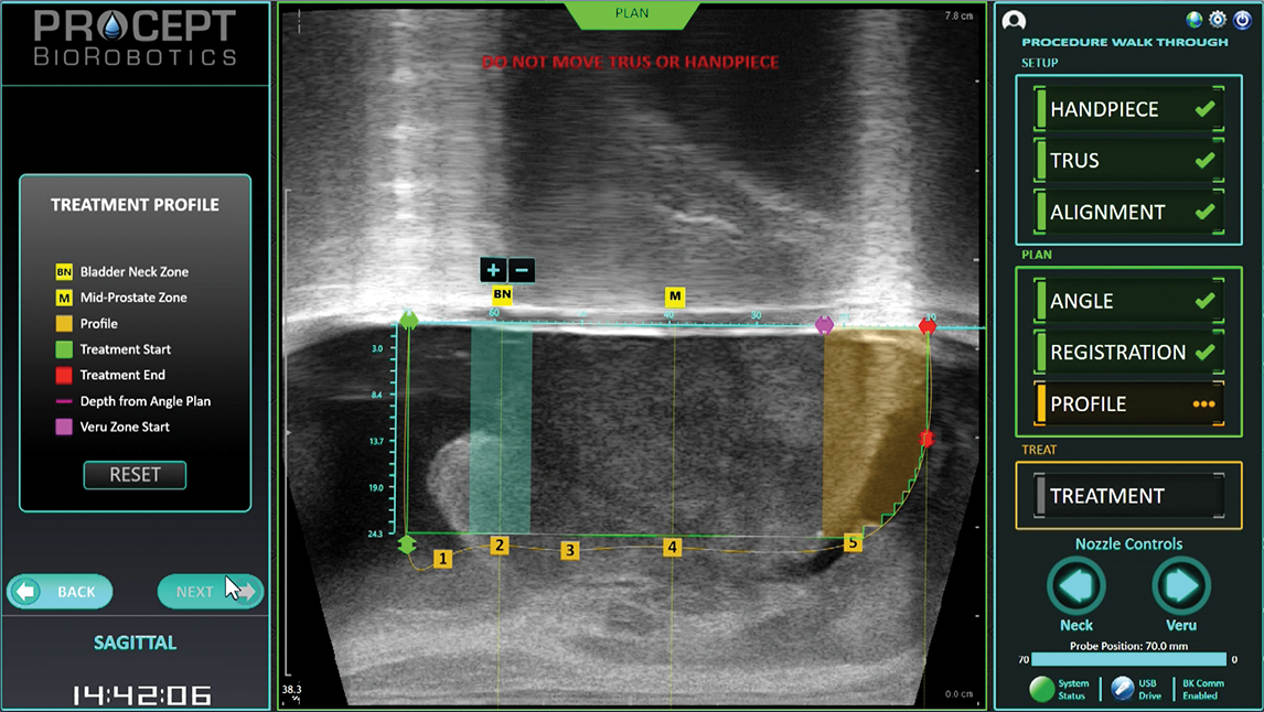 AquaBeam Sagittal View CPU AquaBeam Sagittal View CPU