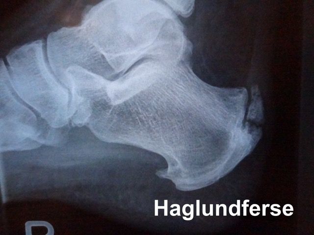 Rötgenbild Ferse UCHHaglundferse72