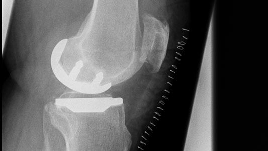 Gelenkersatz Knie Gelenkersatz Knie