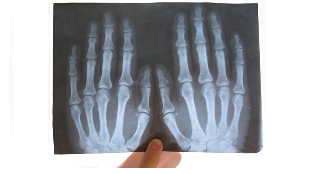Röntgenbild Hand Röntgenbild Hand